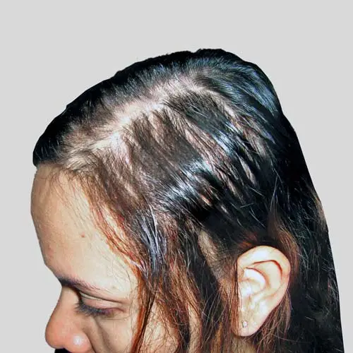 Oily Scalp And Hair Loss